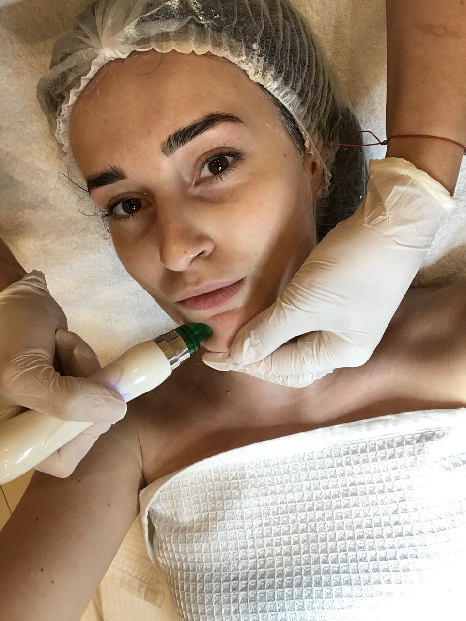 hydrodermabraze hloubkové čištění pletí